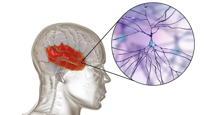 Asombrosa Resiliencia Cerebral: Casos Reales de Supervivencia tras Lesiones Severas