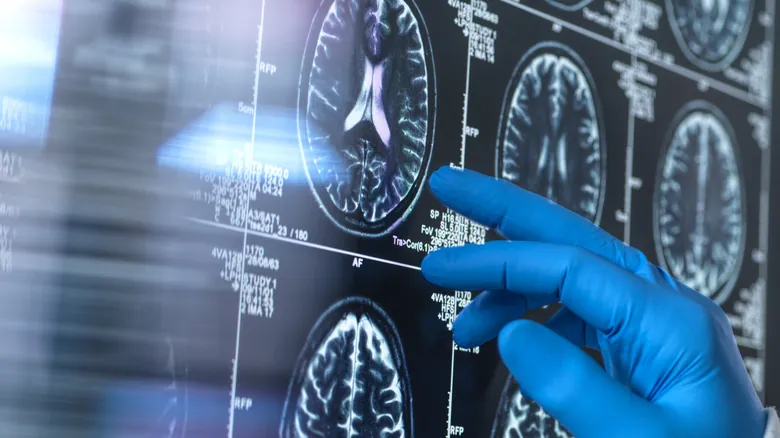 Asombrosa Resiliencia Cerebral: Casos Reales de Supervivencia tras Lesiones Severas